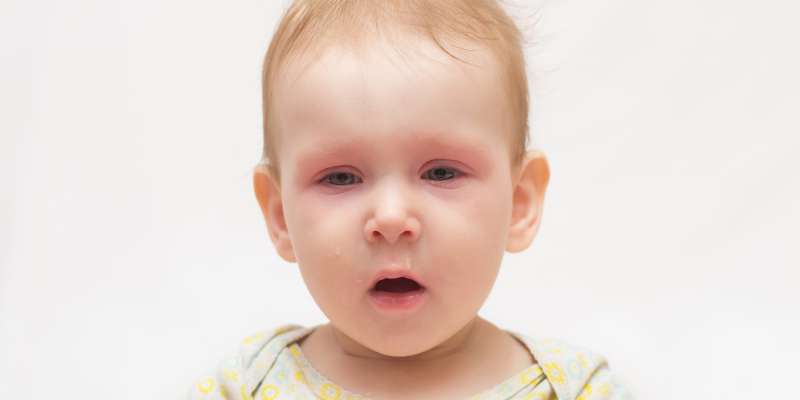 Çocuklarda Göz Kızarıklığı Neden Olur? Nasıl Tedavi Edilir?