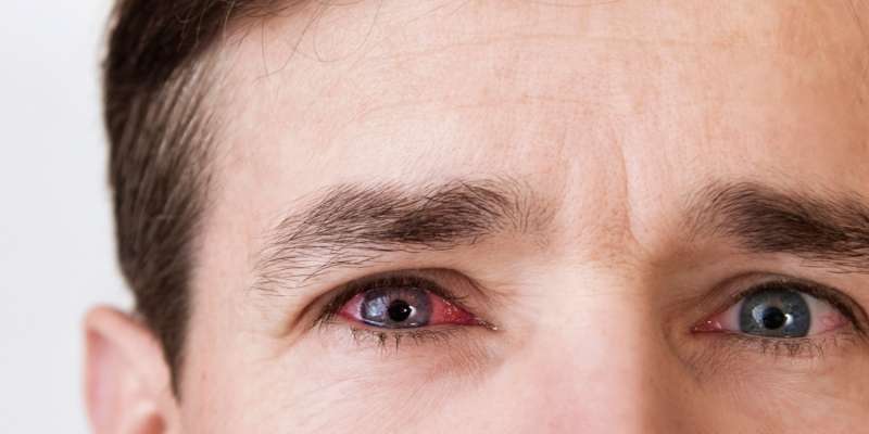 Kuru Göz ve Alerjik Konjonktivit Hastalıkları