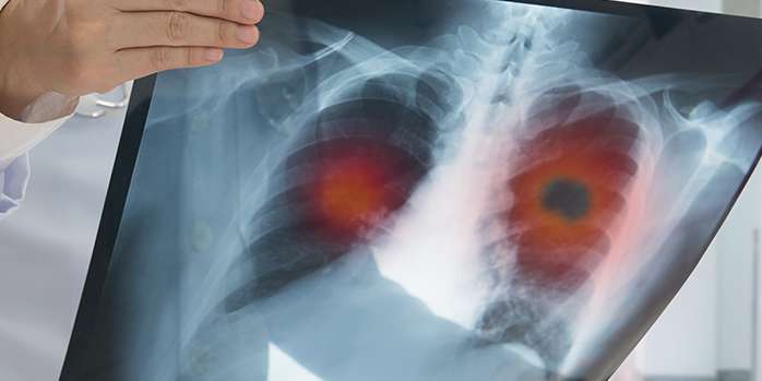 Akciğer Kanseri Belirtileri, Evreleri, Tani Ve Tedavisi