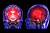 Beyin Kisti Nedir? Beyin Kistinin Belirtileri Nelerdir? Beyin Kisti Tedavisi Nasıl Yapılır? Görseli