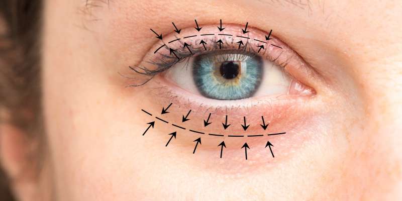 Göz Kapağı Estetiği (Blefaroplasti) Nedir?